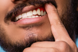 Gum Diseases